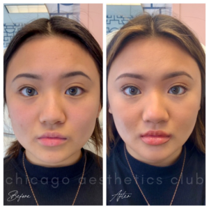 Masseter Botox before and after