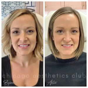 Cheek Filler before and after