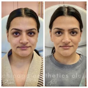 Facial Balancing masseter botox results