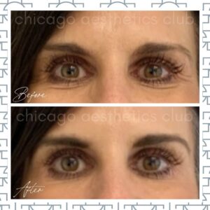 Under Eye Botox results