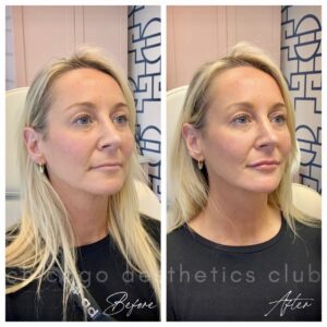 chin definition with jawline filler