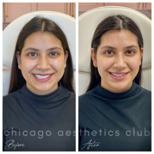 Masseter Botox results chicago