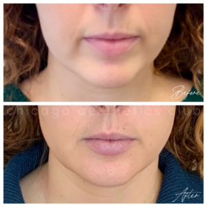 chin filler and jawline filler chicago