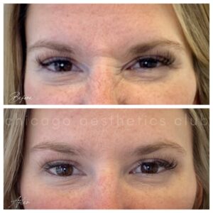Botox Bunny Lines before and after