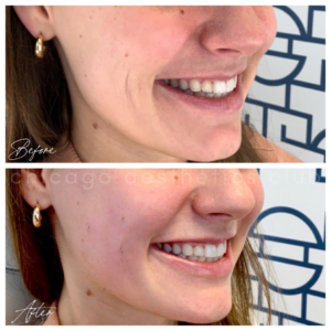 Smile Lines Filler before and after