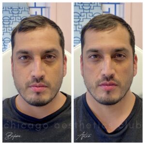 male fillers before and after