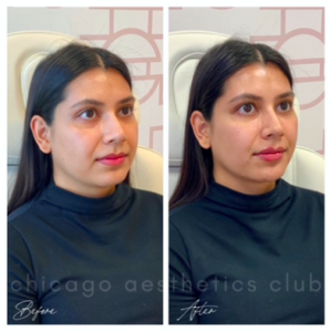 before and after facial balancing treatment