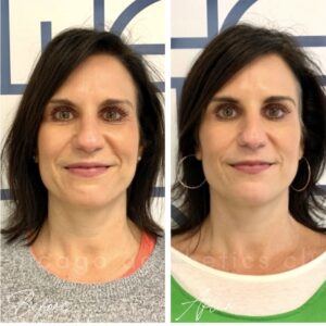 Natural Looking Botox before and after
