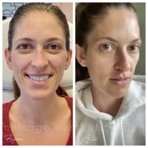 Natural Looking Botox results