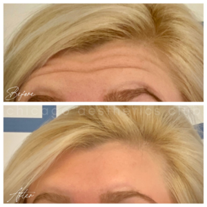 forehead botox results