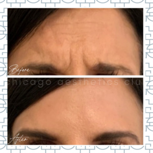 Botox Frown Lines before and after