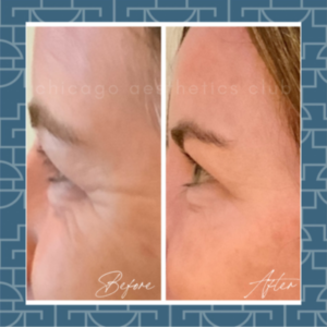 Botox Results Crows Feet