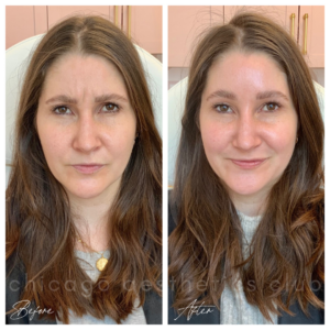 Preventative Botox for frown lines