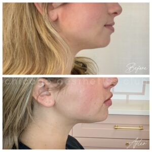 kybella chin before and after